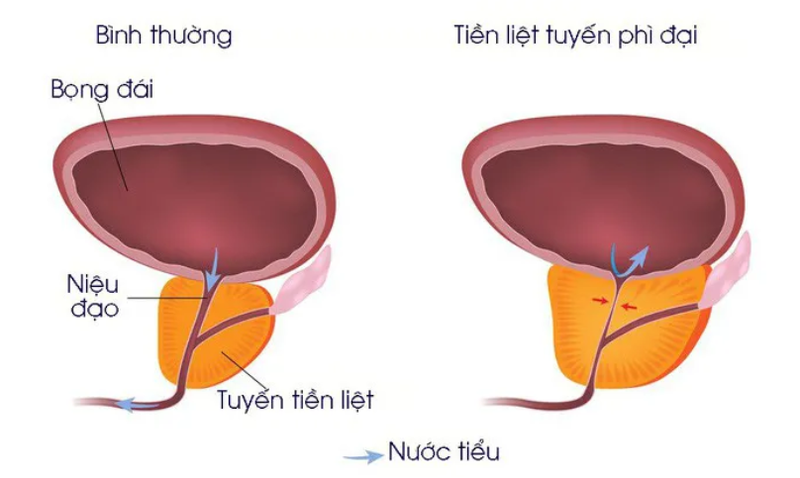 Bệnh về tiền liệt tuyến là gì