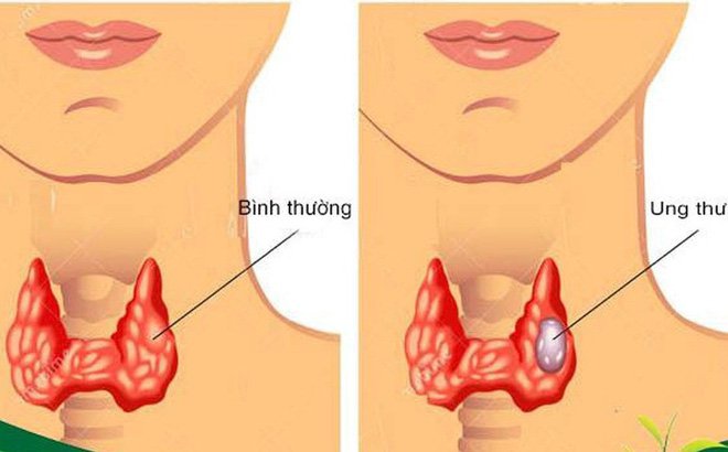 Ung thư tuyến giáp là gì?