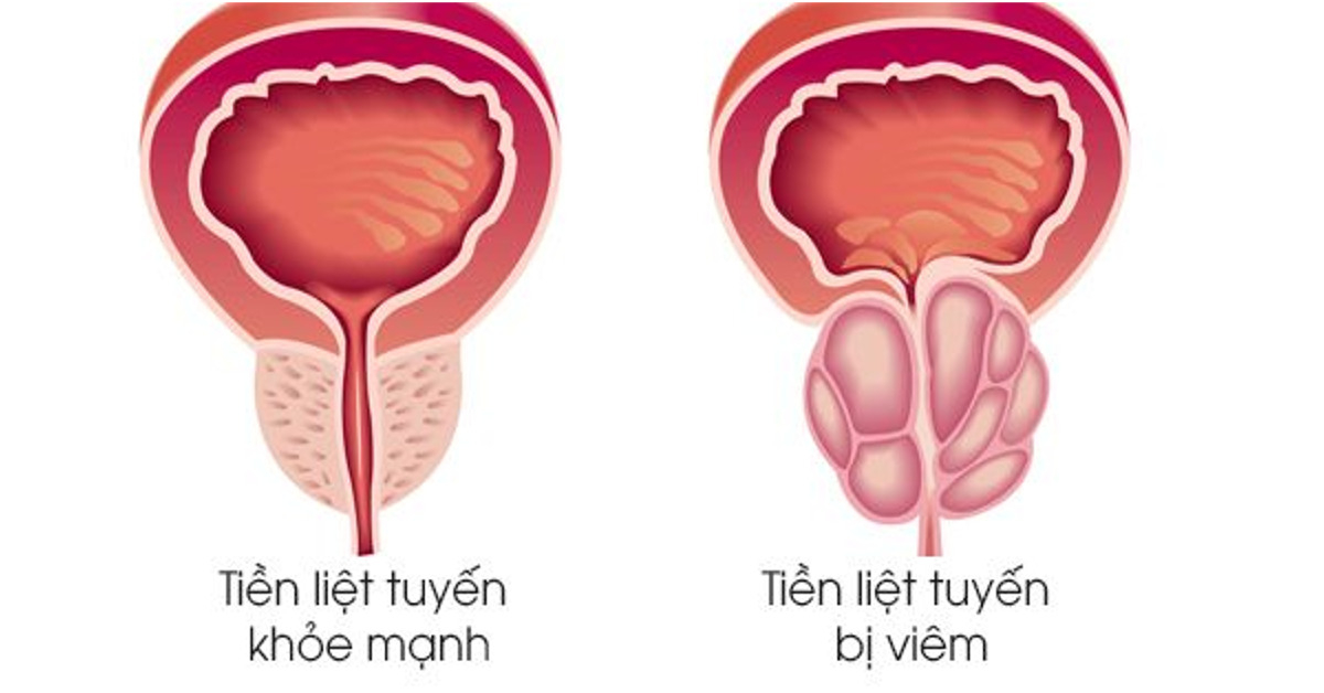 Bệnh viêm tiền liệt tuyến là bệnh gì?